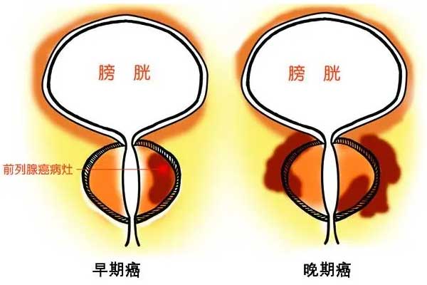 前线腺癌 前线腺癌